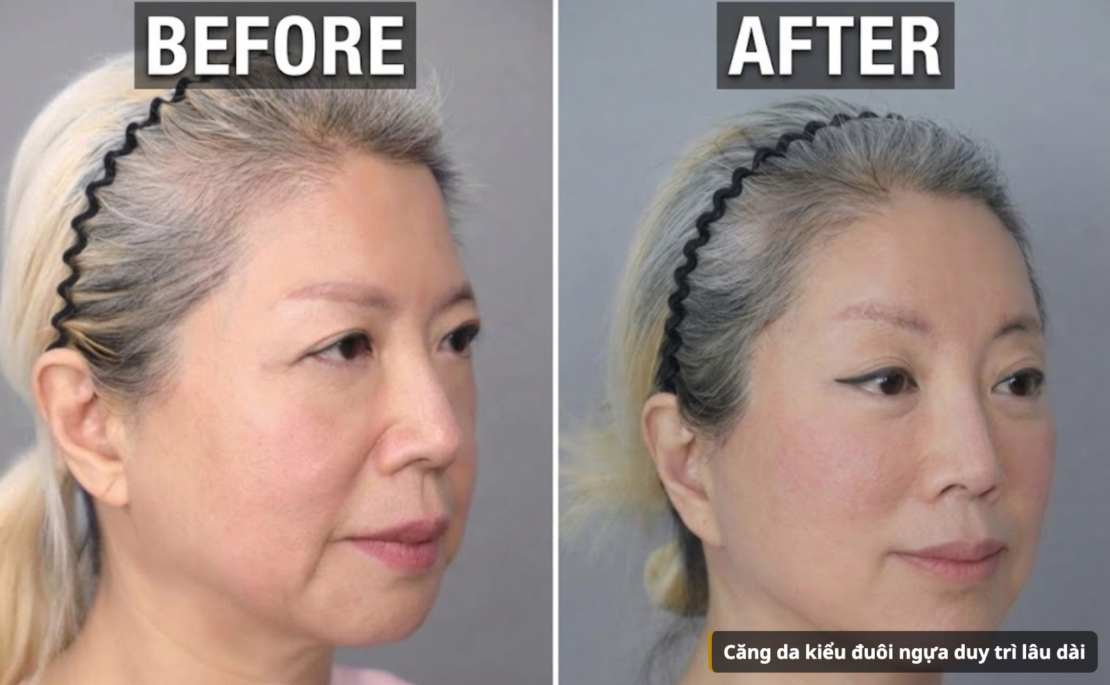 Trước và sau căng da kiểu đuôi ngựa với bóc tách màng xương ba vùng